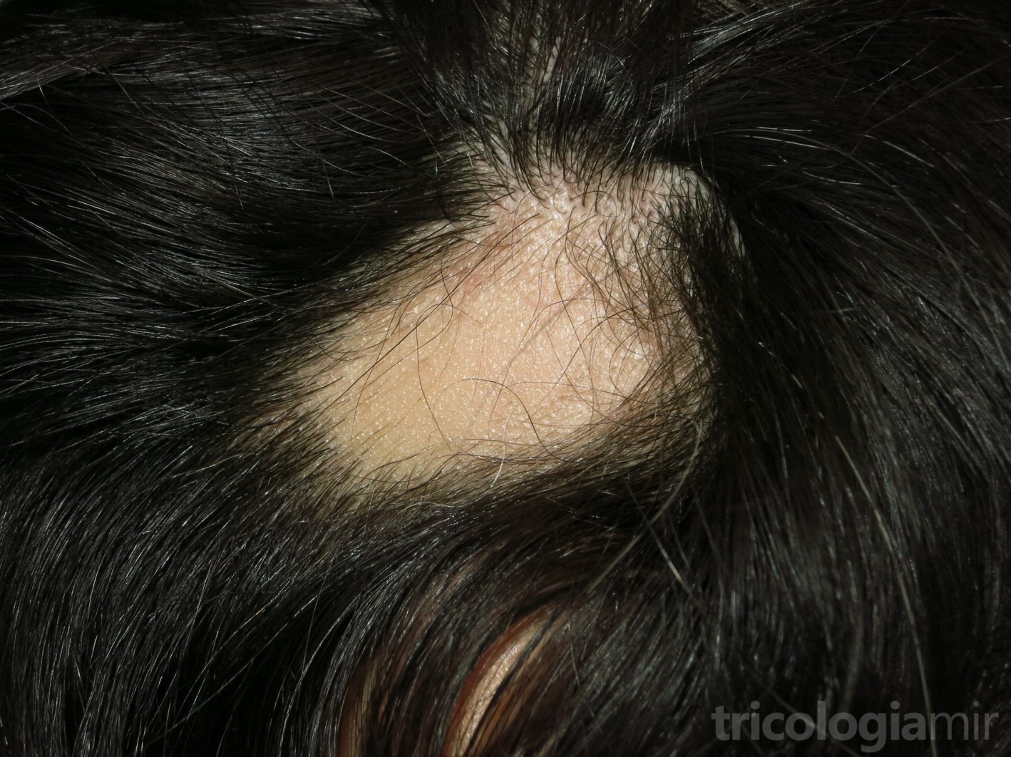 Alopecia Areata Tricolog A Y Trasplante Capilar Mir