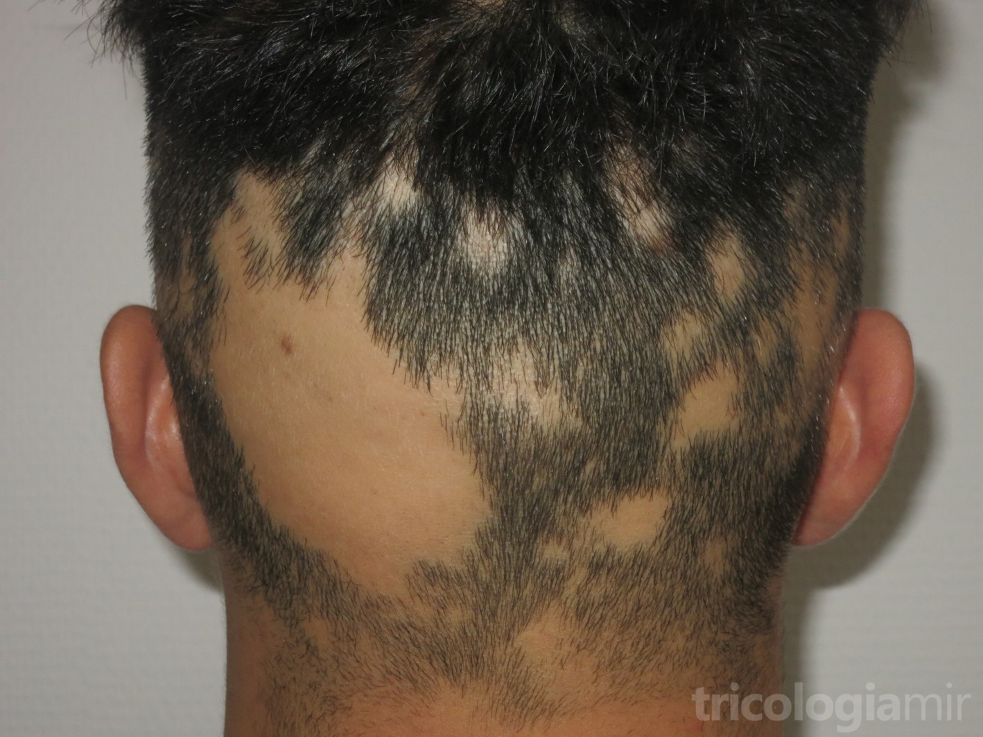 Alopecia areata en placas multifocal de predominio en zona occipital