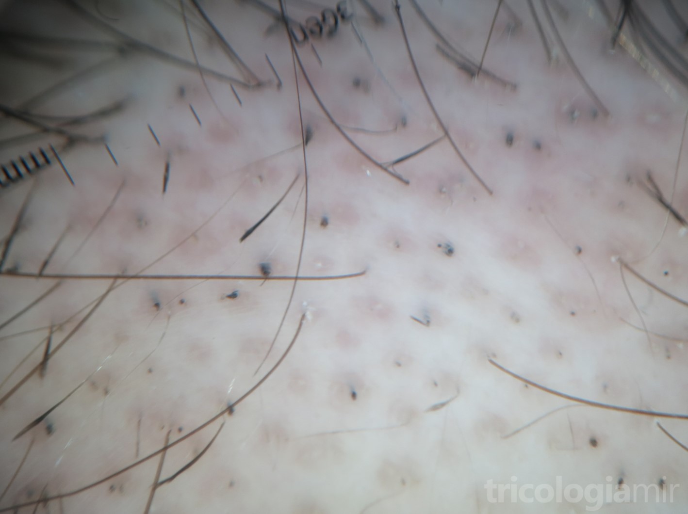 Tricoscopia de alopecia areata con pelos en signo de exclamación y puntos negros