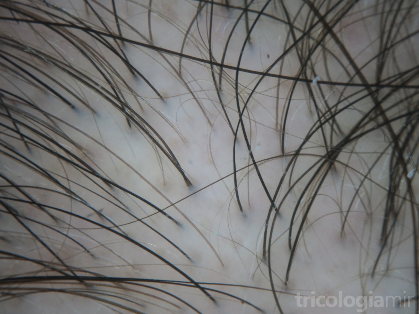 Tricoscopia de FAGA con anisotricosis marcada (cabellos de diferentes diámetros)