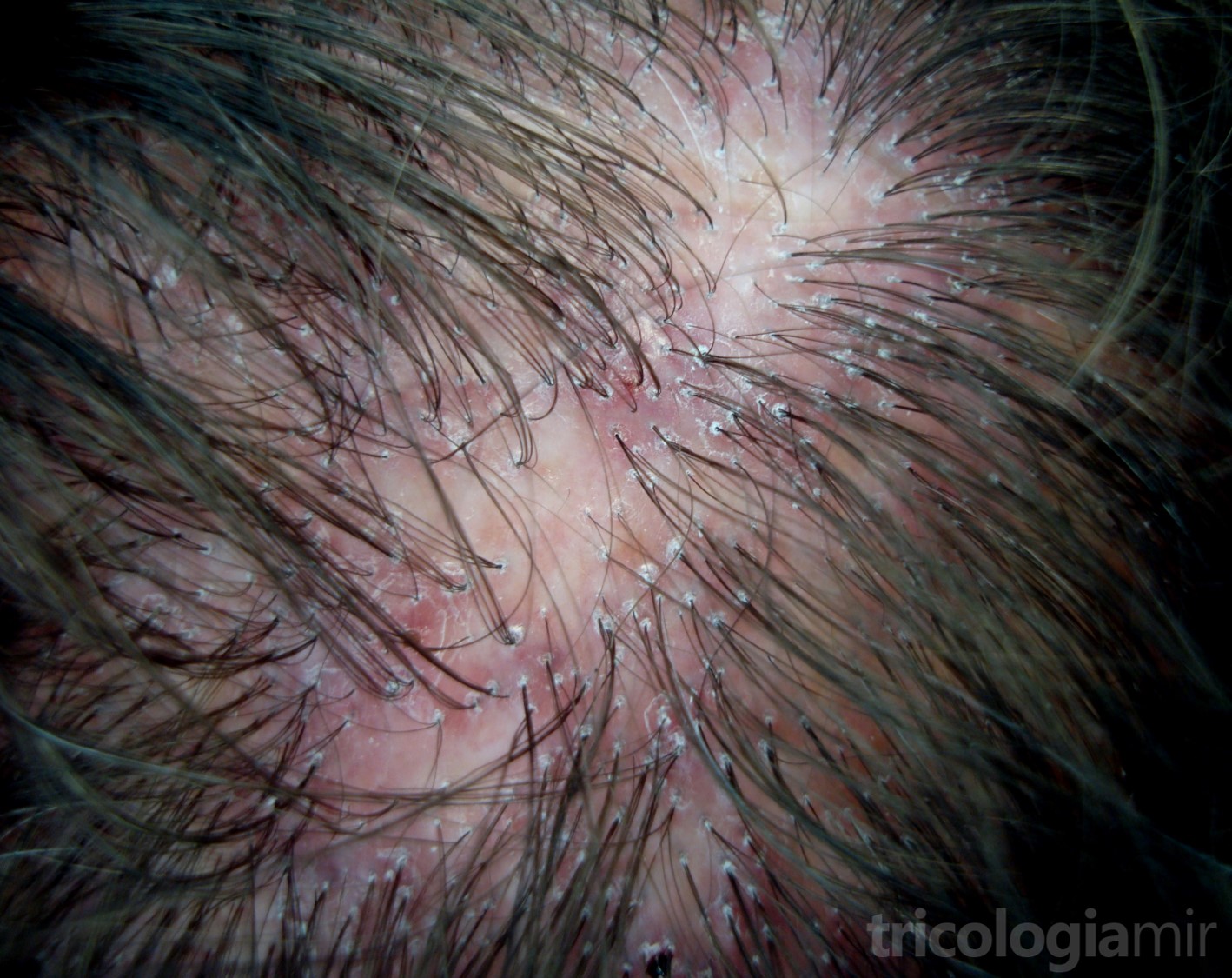 LPP en fase activa con zonas de alopecia parcheadas con hiperqueratosis folicular y eritema marcados
