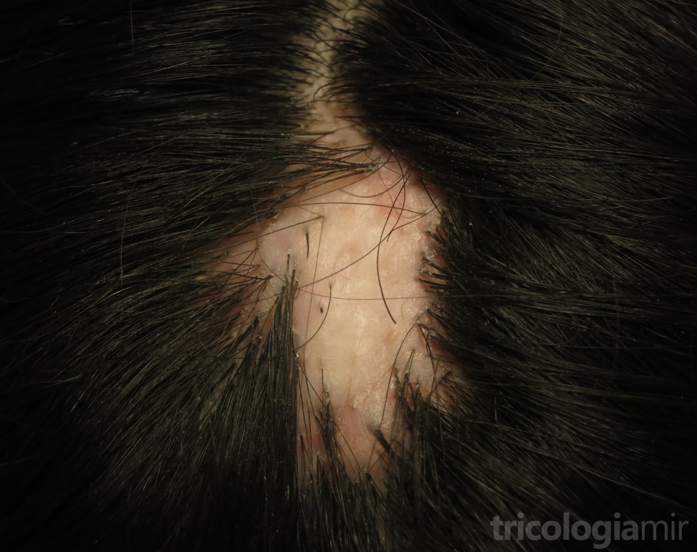 LPP en fase cicatricial con notable placa alopécica en zona vértex sin signos inflamatorios