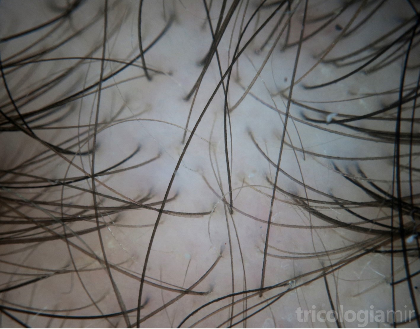 Tricoscopia de MAGA con marcada anisotricosis (cabellos de diferente diámetro)