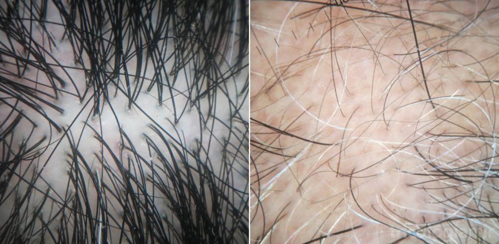 Imágenes tricoscópicas comparando el cuero cabelludo normal (izquierda) con un caso de alopecia androgenética avanzada (derecha).