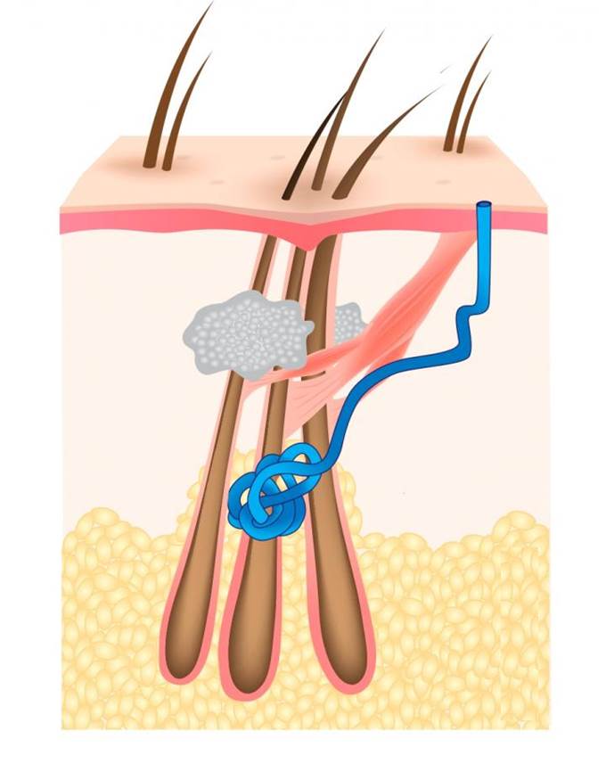 Unidad folicular de 3 folículos con glándulas sebáceas (gris), glándulas ecrinas (azul) y músculo erector del pelo (rosa).