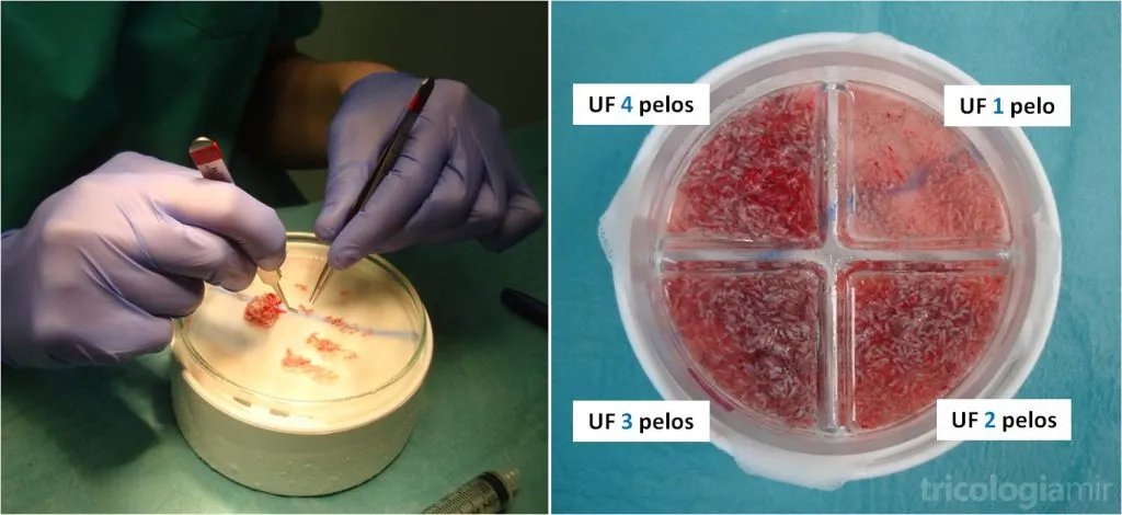 Tratamiento de tricología capilar para fortalecer el cabello y prevenir la caída.