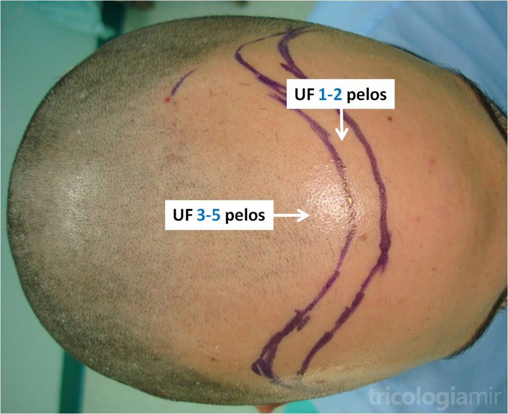 Las UF de 1 y 2 pelos se implantan en la línea de implantación capilar mientras que las UF de 3 o más pelos aportan más densidad en las zonas más posteriores.