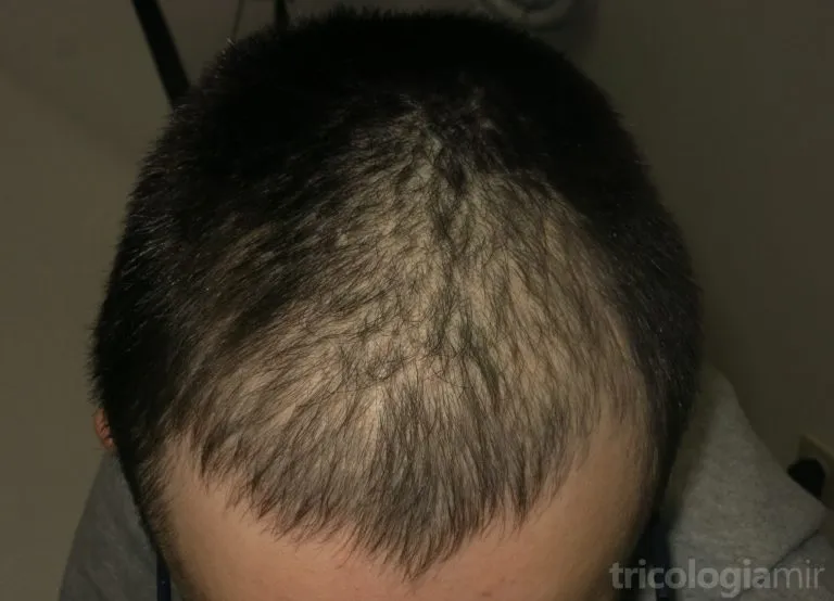 Técnicas avanzadas en trasplante capilar para recuperar densidad.