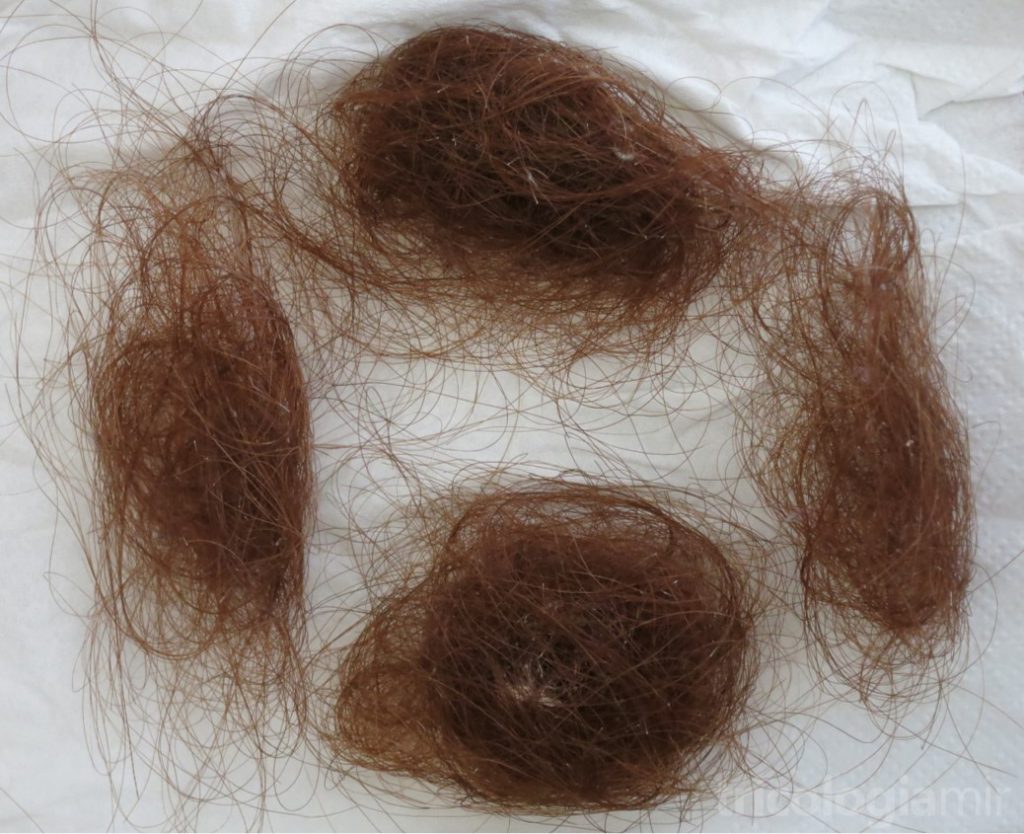 Caída masiva de pelo por efluvio telógeno iniciada 2 meses después de infección por SARS-CoV-2.