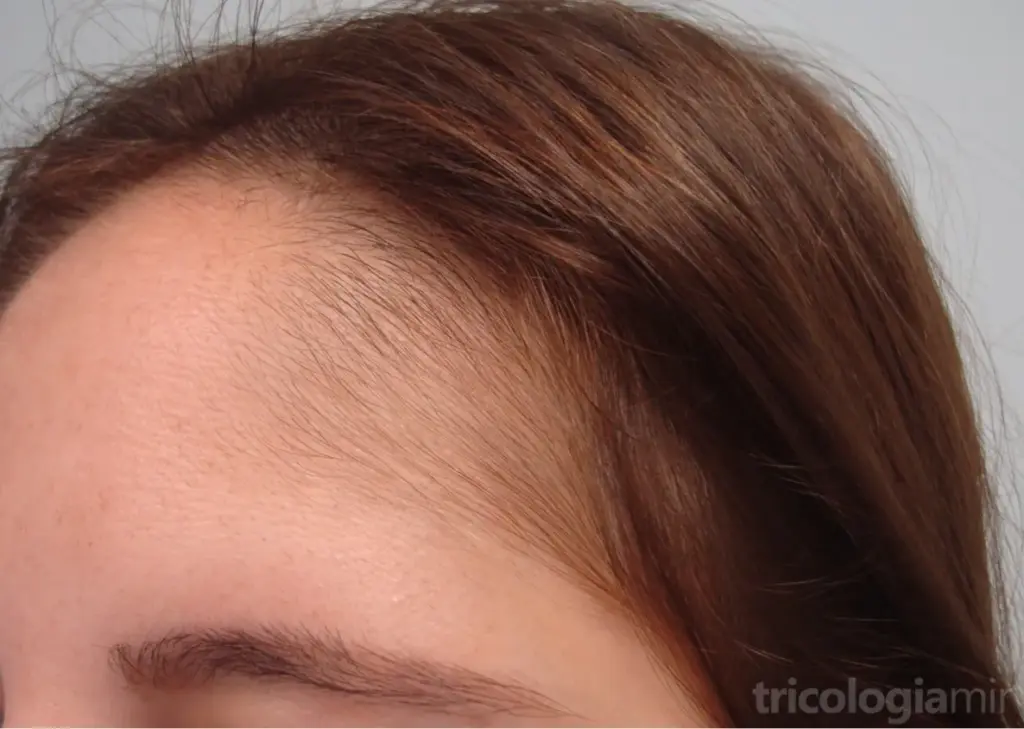Aplicación de finasteride en tratamientos de tricología para la regeneración capilar.