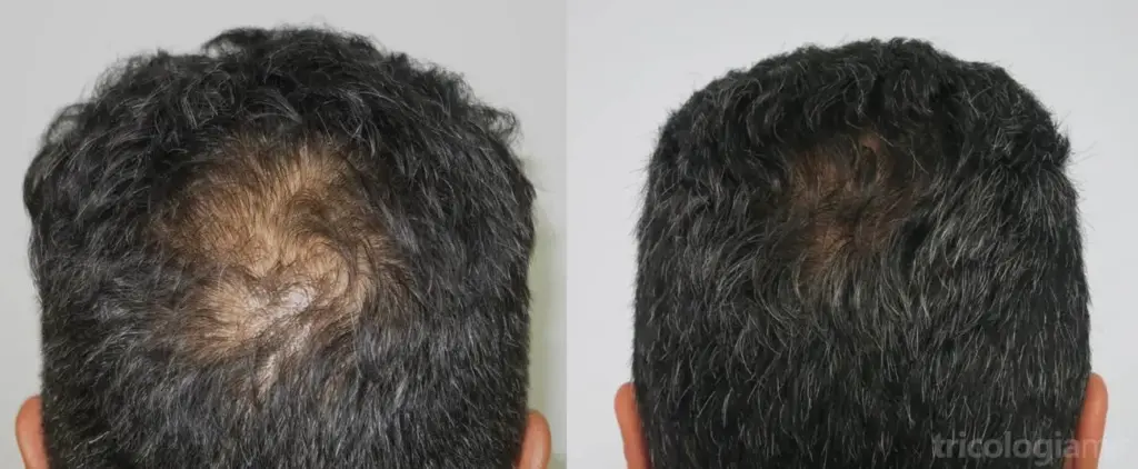 Resultados visibles tras un tratamiento capilar especializado.