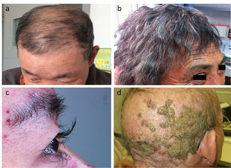 Principales reacciones capilares por inhibidores EGFR: a) alopecia, b) cambios morfológicos, c) tricomegalia pestañas, d) dermatosis pustulosa erosiva de cuero cabelludo.