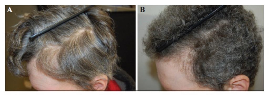 “Rasophatic alopecia” por vemurafenib (inhibidor de BRAF) en un paciente con melanoma metastásico.