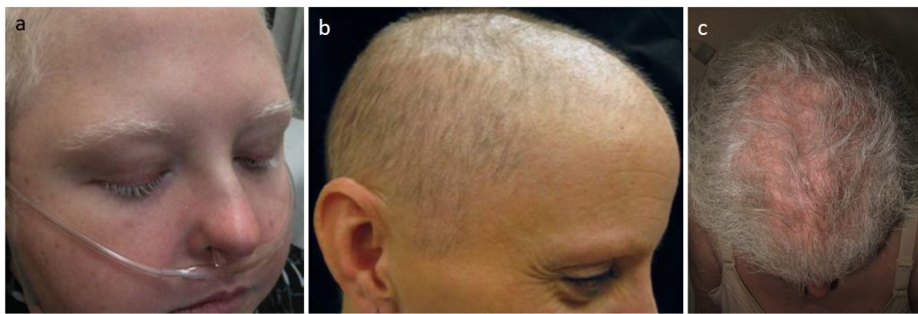 Principales reacciones capilares por inhibidores c-kit: a) despigmentación, b) “nilotinib-induced alopecia”, c) liquen plano pilar.