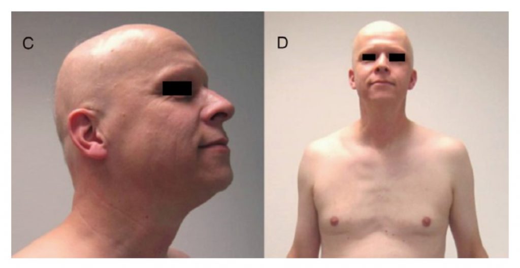 Alopecia areata universal por alemtuzumab (anti-CD52).