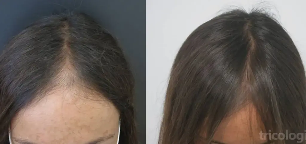 Tratamiento de tricología capilar para fortalecer el cabello y prevenir la caída.