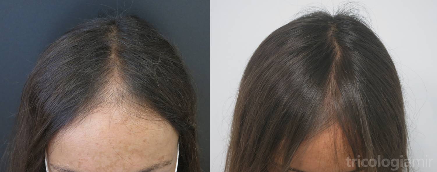 Loza de barro bordillo Disfraz Tratamiento médico de la alopecia androgenética femenina (FAGA) -  Tricología y Trasplante Capilar Mir