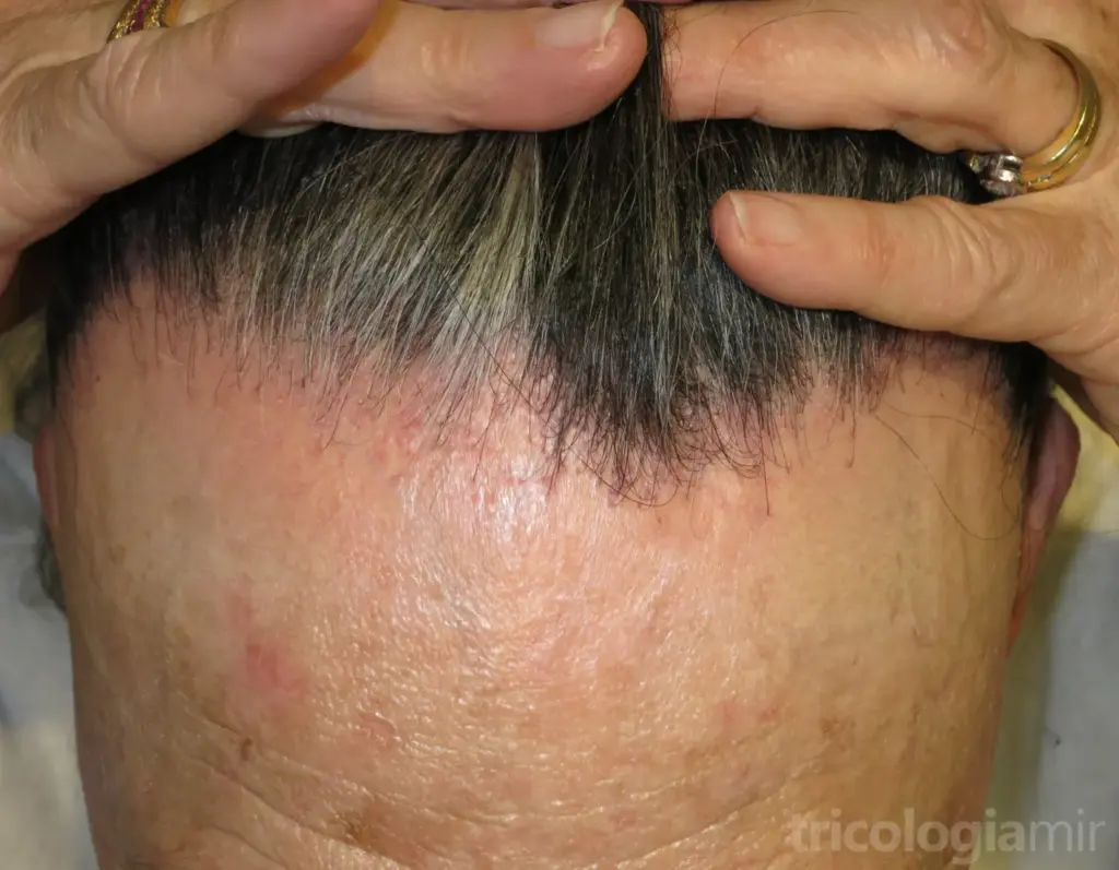 AFF en fase inicial con retraso de la línea de implantación y eritema visible