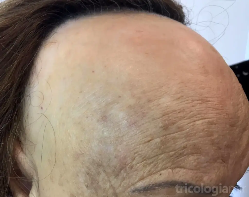 AFF avanzada con retraso muy importante de la línea de implantación y pérdida de cejas