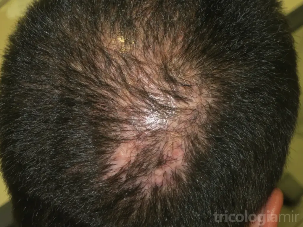 Foliculitis decalvans en fase estable con placas alopécicas cicatriciales parcheadas en vértex sin signos de inflamación activa
