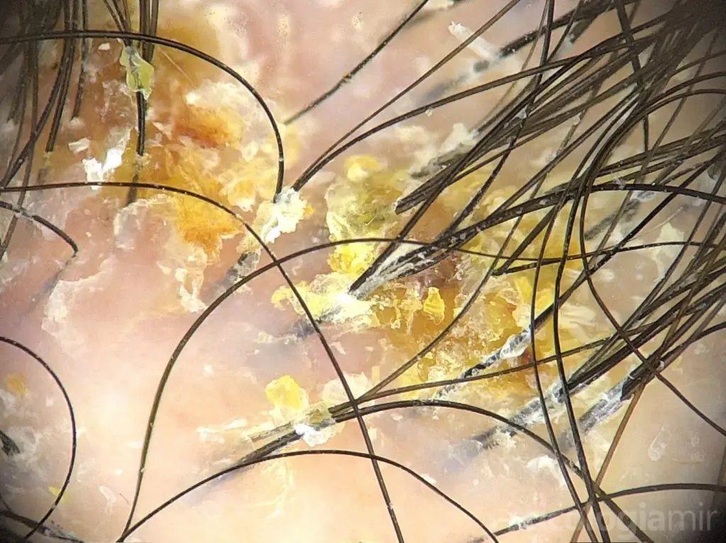 Tricoscopia de foliculitis decalvans en brote con hiperqueratosis folicular, costras amarillentas y descamación tubular