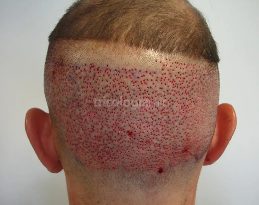 Zona donante tras extracción de 2500 unidades foliculares mediante técnica FUE con micropunch de 0,8mm