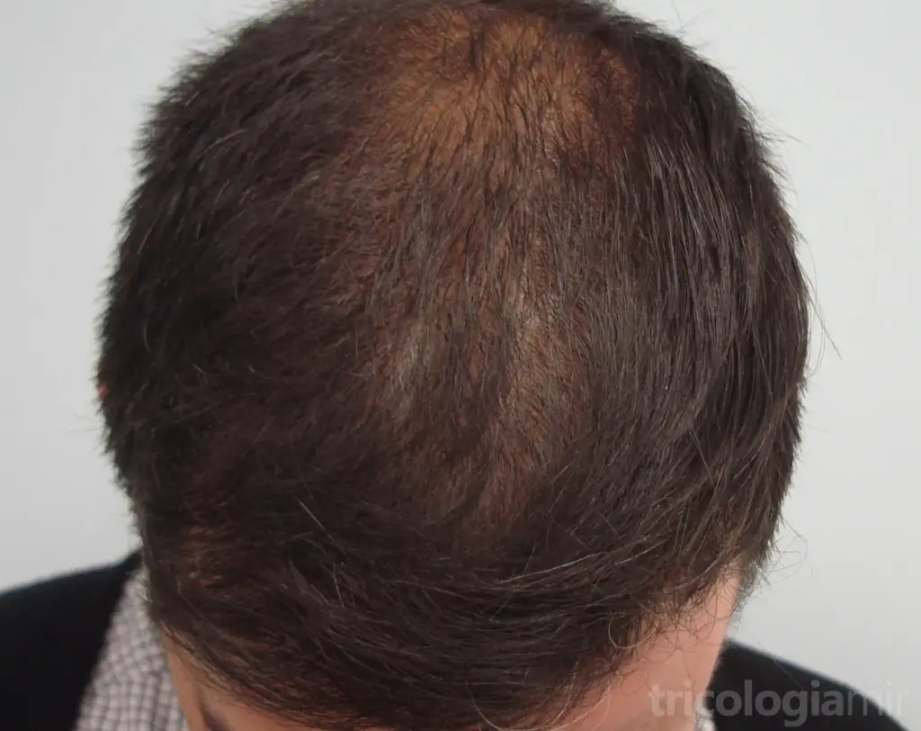 Mejoría notable tras realizar tratamiento con Dutasteride 0,5mg/d durante 1 año