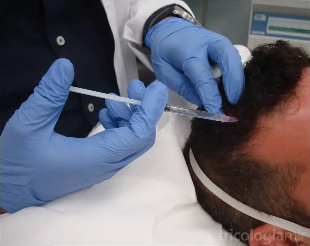 Se infiltra 1ml de dutasteride sobre las zonas afectadas de alopecia androgenética