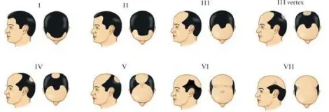 Escala Hamilton-Norwood